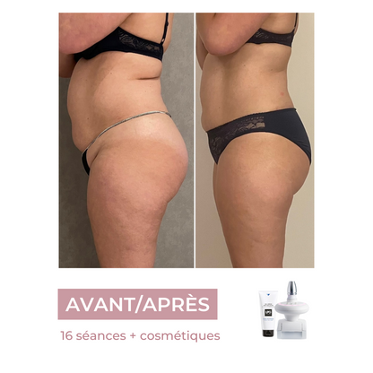 Séance endermologie